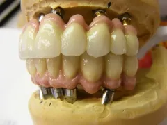 Implant