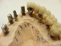 Implant