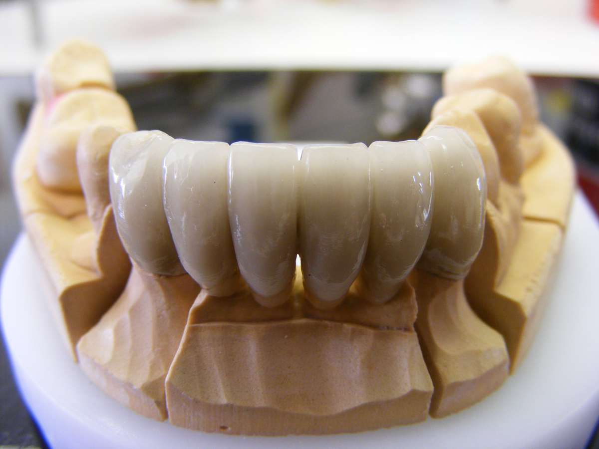 Crown and Bridge