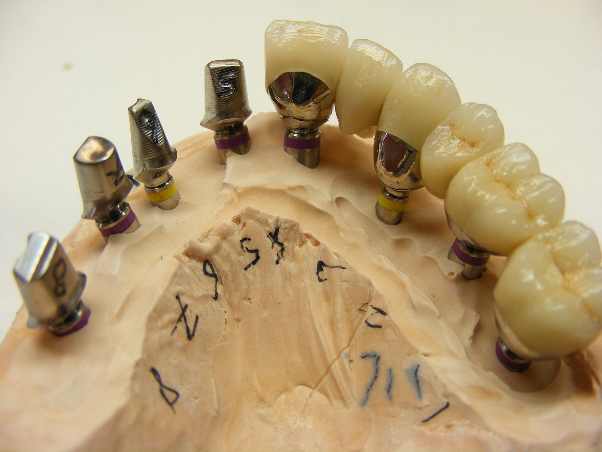 Implant