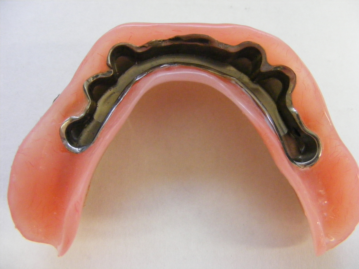 Implant milled bar
