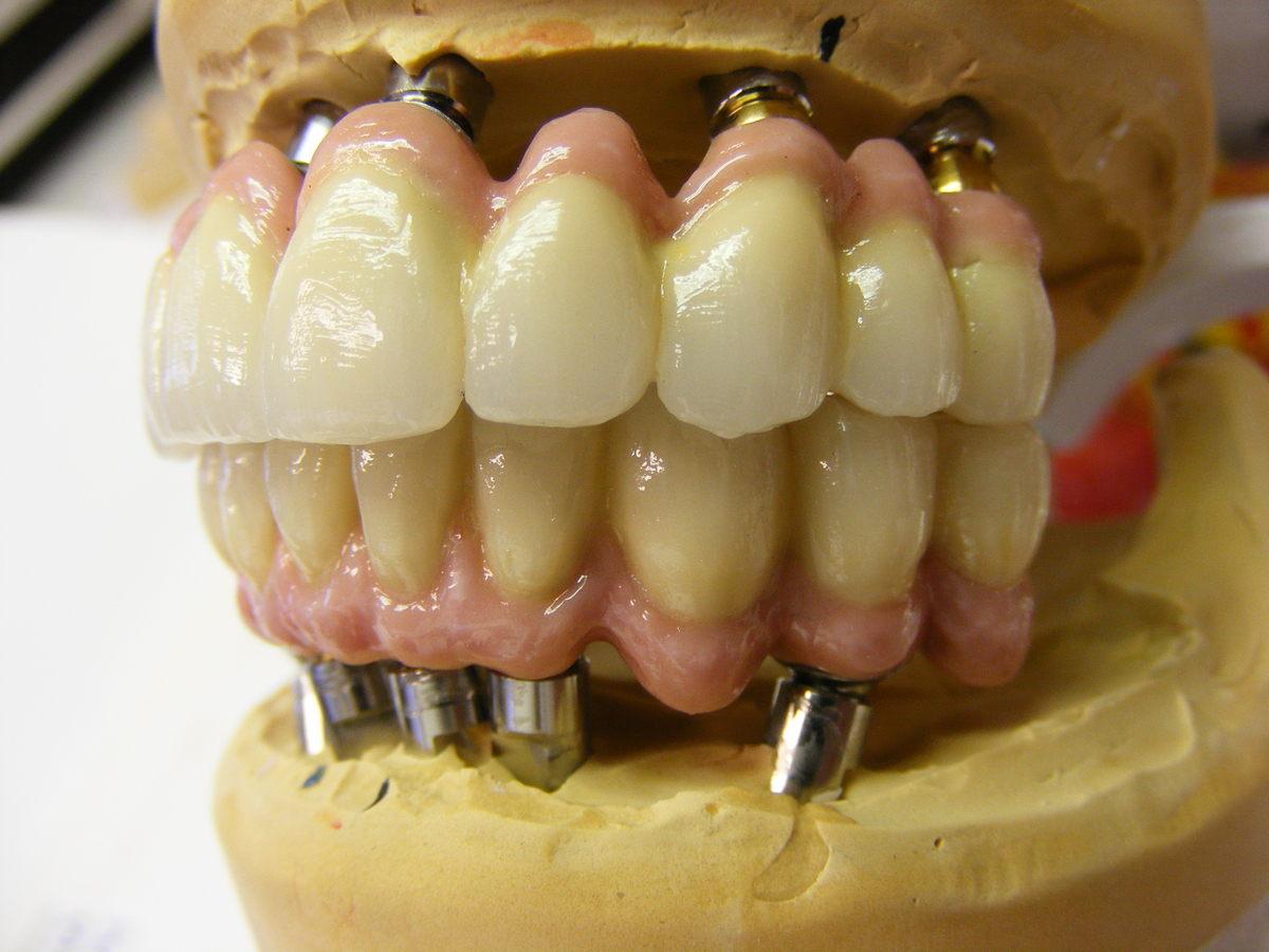 Implant